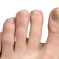 Natural remedies to cure fungal toenails
